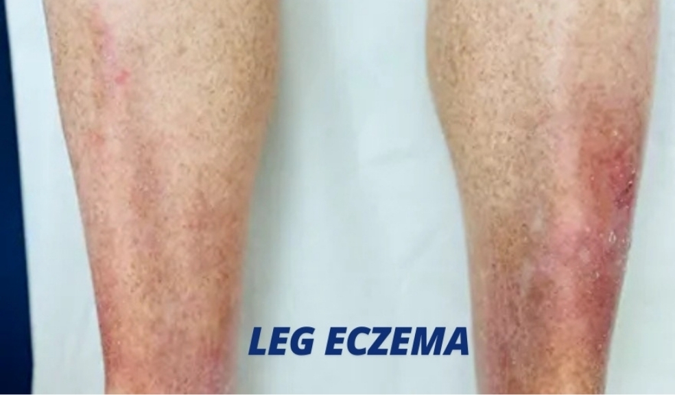 is eczema communicable